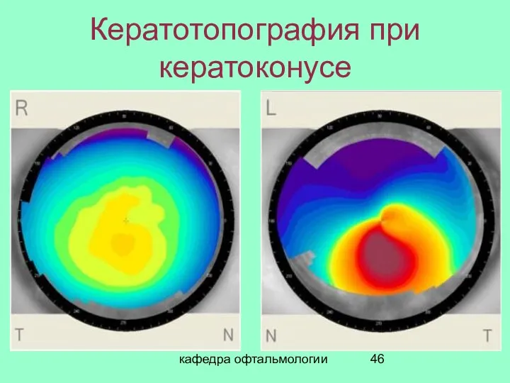 кафедра офтальмологии Кератотопография при кератоконусе