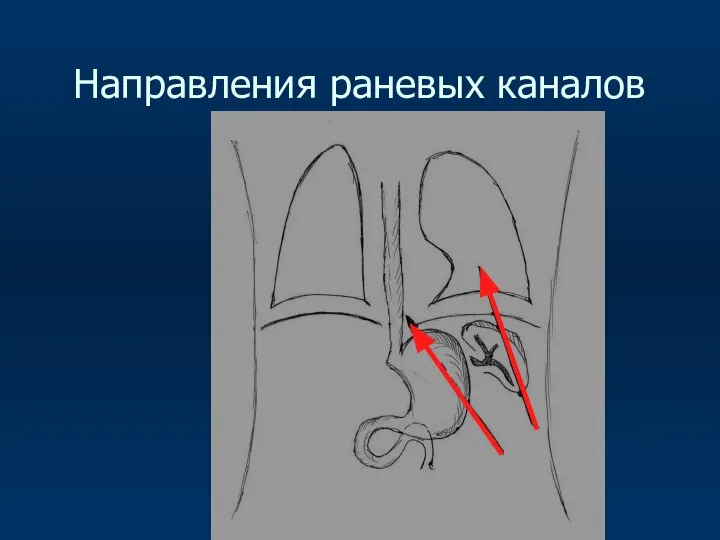 Направления раневых каналов