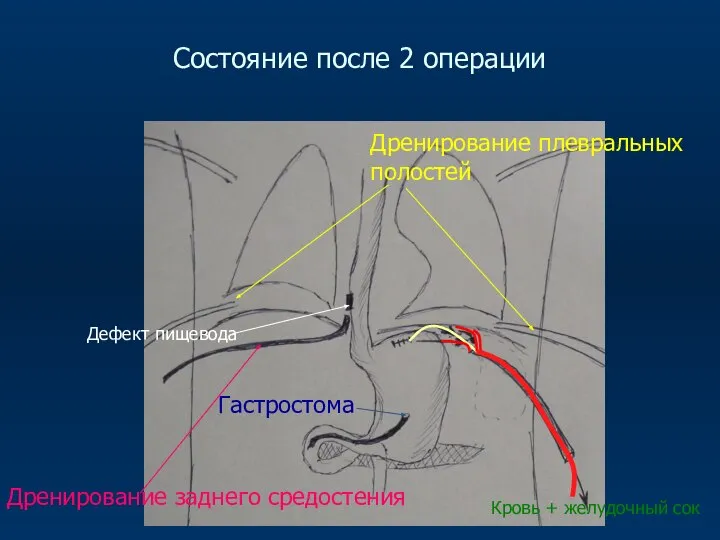 Состояние после 2 операции Дренирование плевральных полостей Дренирование заднего средостения Гастростома Кровь