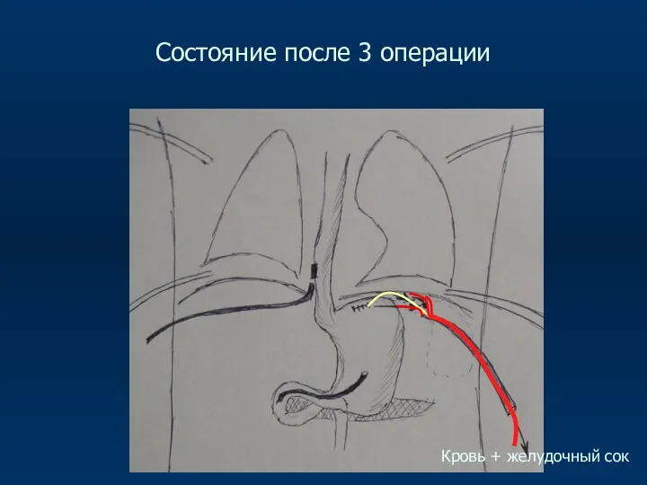 Состояние после 3 операции Кровь + желудочный сок