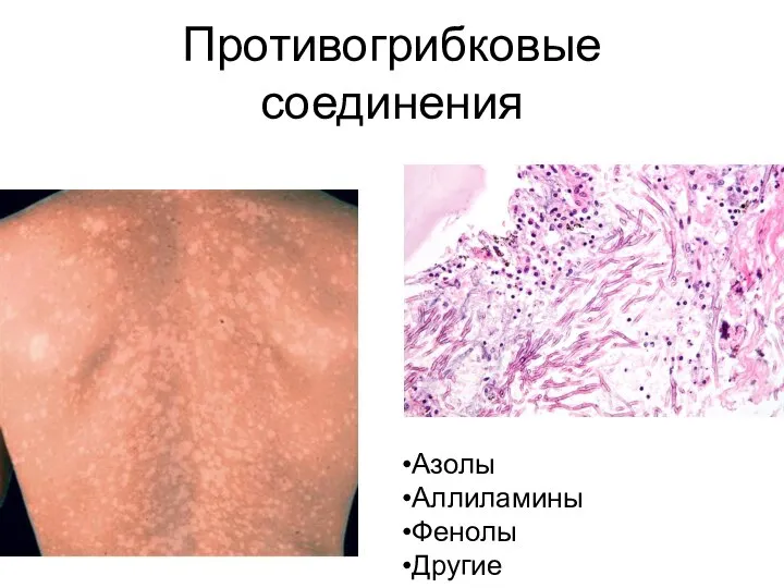 Противогрибковые соединения Азолы Аллиламины Фенолы Другие