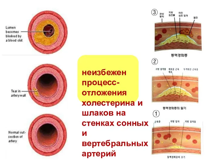 неизбежен процесс- отложения холестерина и шлаков на стенках сонных и вертебральных артерий