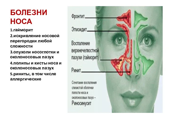 БОЛЕЗНИ НОСА 1.гайморит 2.искривление носовой перегородки любой сложности 3.опухоли носоглотки и околоносовых