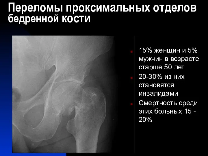 Переломы проксимальных отделов бедренной кости 15% женщин и 5% мужчин в возрасте
