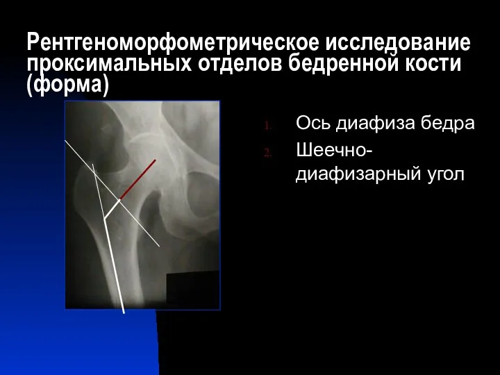 Рентгеноморфометрическое исследование проксимальных отделов бедренной кости (форма) Ось диафиза бедра Шеечно-диафизарный угол