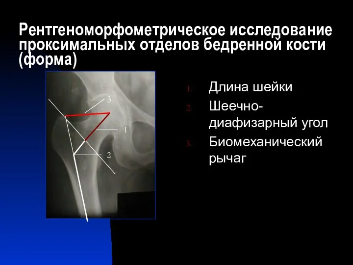 Рентгеноморфометрическое исследование проксимальных отделов бедренной кости (форма) Длина шейки Шеечно-диафизарный угол Биомеханический рычаг 1 2 3