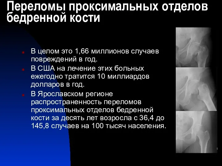 Переломы проксимальных отделов бедренной кости В целом это 1,66 миллионов случаев повреждений