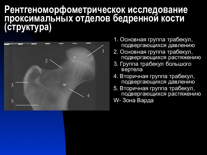 Рентгеноморфометрическок исследование проксимальных отделов бедренной кости (структура) 1. Основная группа трабекул, подвергающихся