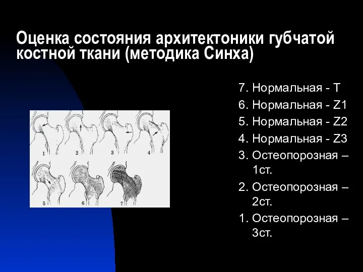 Оценка состояния архитектоники губчатой костной ткани (методика Синха) 7. Нормальная - Т