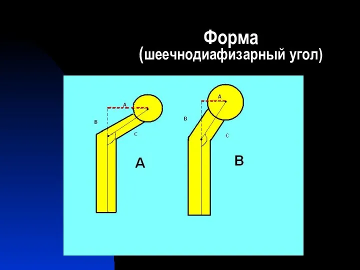 Форма (шеечнодиафизарный угол)