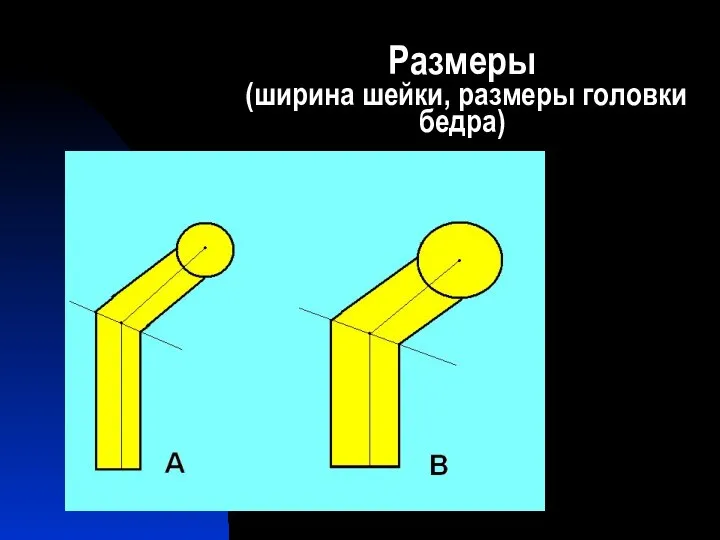 Размеры (ширина шейки, размеры головки бедра)