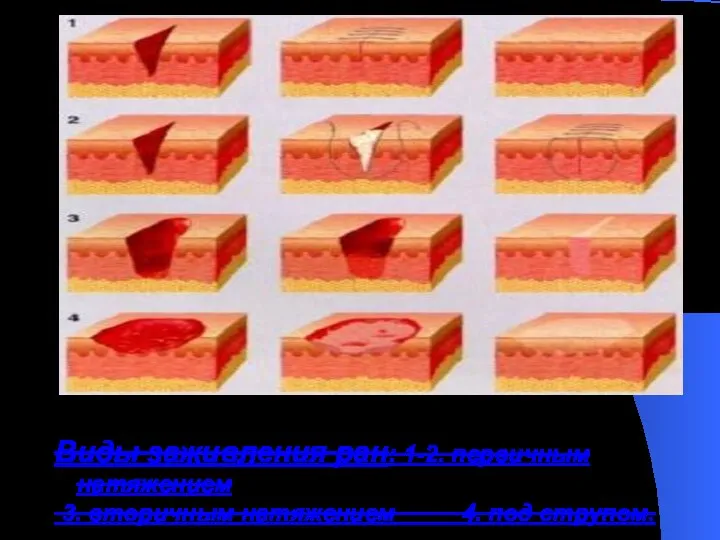 Виды заживления ран: 1-2. первичным натяжением 3. вторичным натяжением 4. под струпом.