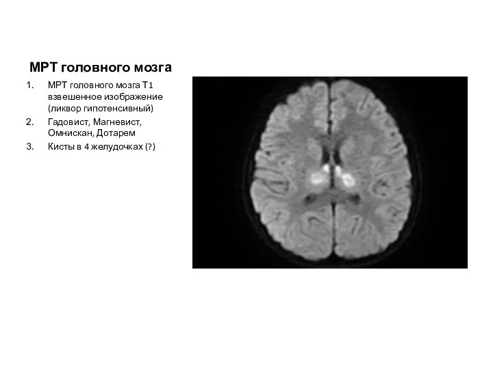 МРТ головного мозга МРТ головного мозга Т1 взвешенное изображение(ликвор гипотенсивный) Гадовист, Магневист,