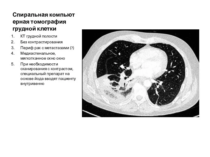 Спиральная компьютерная томография грудной клетки КТ грудной полости Без контрастирования Периф рак