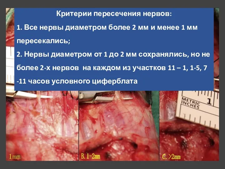 Критерии пересечения нервов: 1. Все нервы диаметром более 2 мм и менее