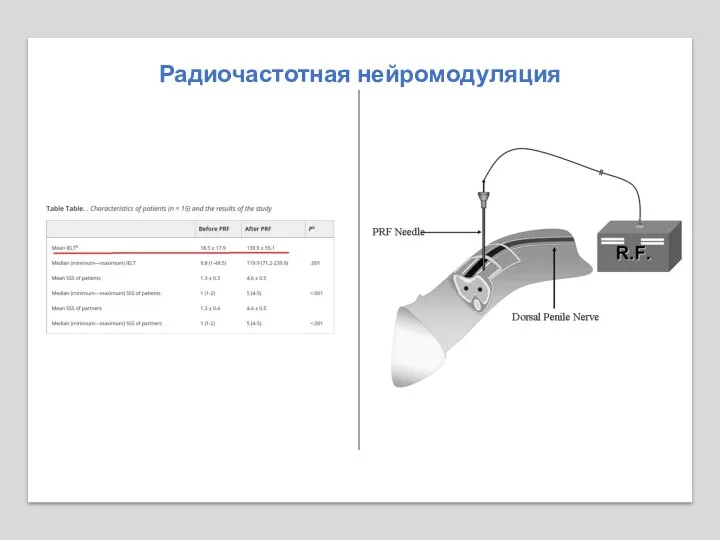 Радиочастотная нейромодуляция