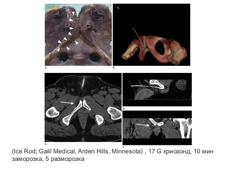 (Ice Rod; Galil Medical, Arden Hills, Minnesota) , 17 G криозонд, 10 мин заморозка, 5 разморозка