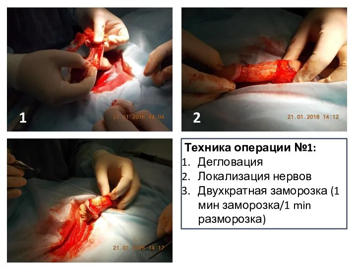 Техника операции №1: Дегловация Локализация нервов Двухкратная заморозка (1 мин заморозка/1 min разморозка) 1 2