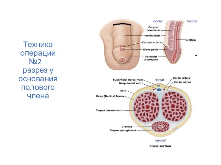 Техника операции №2 – разрез у основания полового члена Техника операции №2