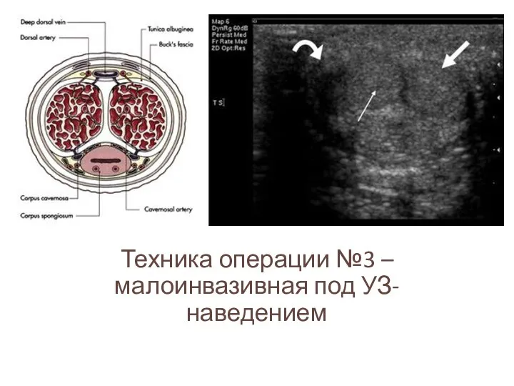 Техника операции №3 – малоинвазивная под УЗ-наведением