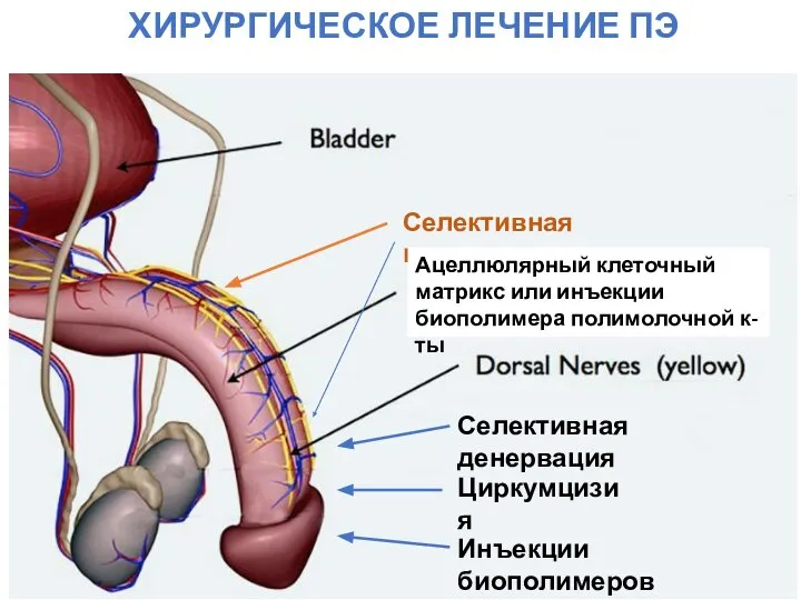 ХИРУРГИЧЕСКОЕ ЛЕЧЕНИЕ ПЭ Циркумцизия Инъекции биополимеров Селективная денервация Селективная криоденервация Ацеллюлярный клеточный