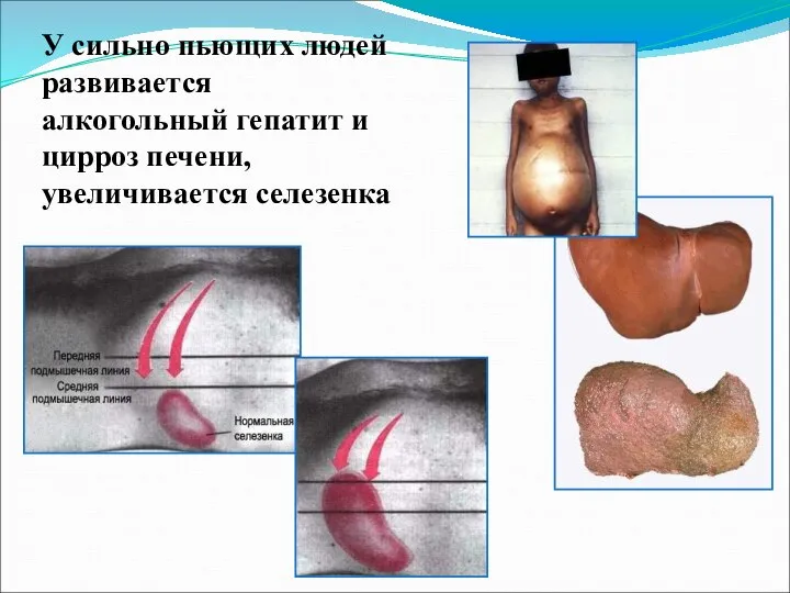 У сильно пьющих людей развивается алкогольный гепатит и цирроз печени, увеличивается селезенка