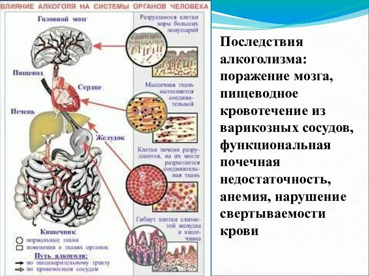 Последствия алкоголизма: поражение мозга, пищеводное кровотечение из варикозных сосудов, функциональная почечная недостаточность, анемия, нарушение свертываемости крови