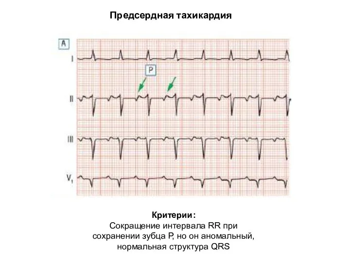 Предсердная тахикардия Критерии: Сокращение интервала RR при сохранении зубца Р, но он аномальный, нормальная структура QRS
