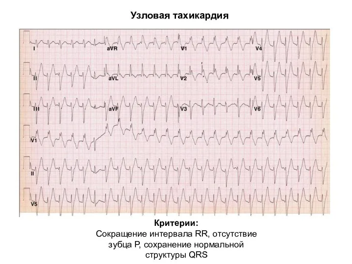 Узловая тахикардия Критерии: Сокращение интервала RR, отсутствие зубца Р, сохранение нормальной структуры QRS