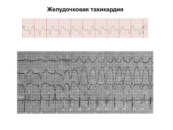 Желудочковая тахикардия