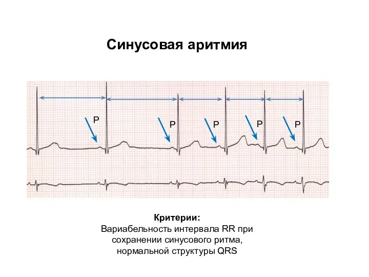 Синусовая аритмия Критерии: Вариабельность интервала RR при сохранении синусового ритма, нормальной структуры