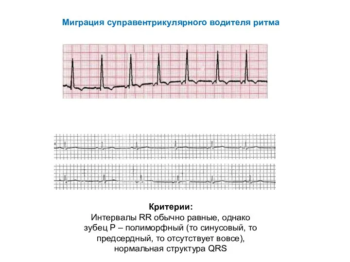 Миграция суправентрикулярного водителя ритма Критерии: Интервалы RR обычно равные, однако зубец Р