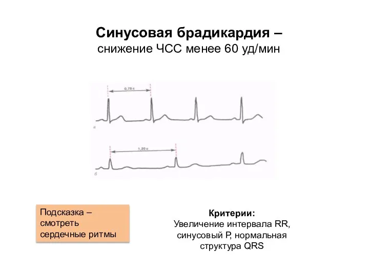 Синусовая брадикардия – снижение ЧСС менее 60 уд/мин Подсказка – смотреть сердечные