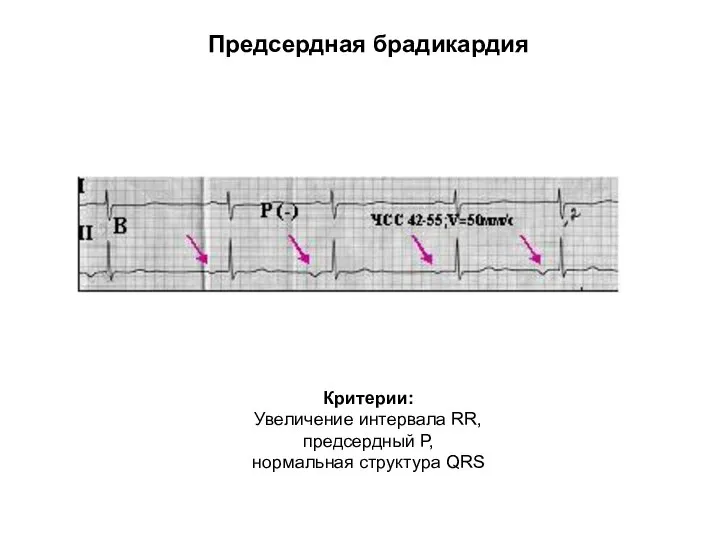 Предсердная брадикардия Критерии: Увеличение интервала RR, предсердный Р, нормальная структура QRS