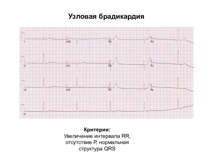 Узловая брадикардия Критерии: Увеличение интервала RR, отсутствие Р, нормальная структура QRS