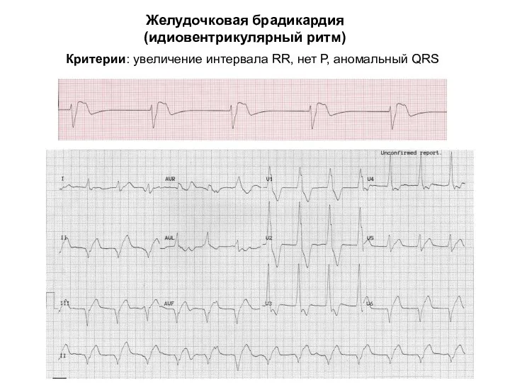 Желудочковая брадикардия (идиовентрикулярный ритм) Критерии: увеличение интервала RR, нет Р, аномальный QRS