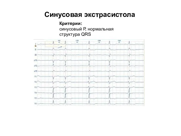 Синусовая экстрасистола Критерии: синусовый Р, нормальная структура QRS