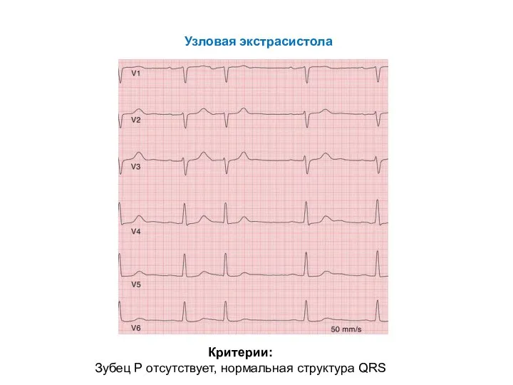 Узловая экстрасистола Критерии: Зубец Р отсутствует, нормальная структура QRS