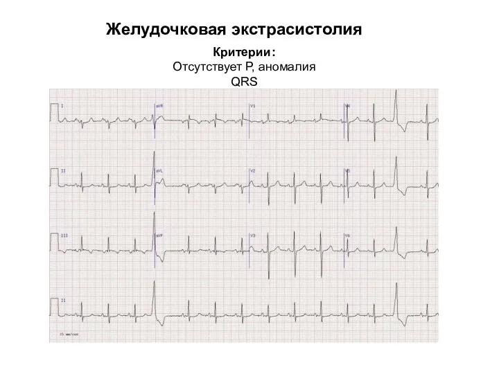 Желудочковая экстрасистолия Критерии: Отсутствует Р, аномалия QRS