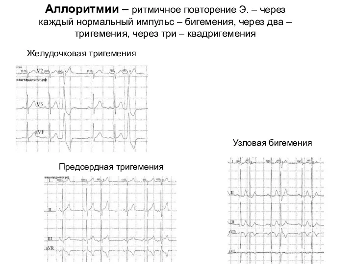 Желудочковая тригемения Аллоритмии – ритмичное повторение Э. – через каждый нормальный импульс