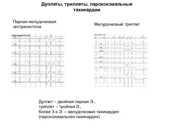 Парная желудочковая экстрасистола Дуплеты, триплеты, пароксизмальные тахикардии Желудочковый триплет Дуплет – двойная