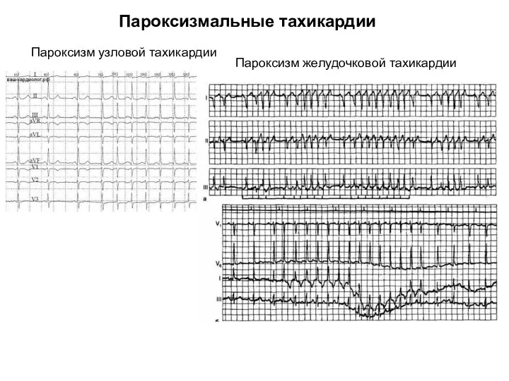 Пароксизм узловой тахикардии Пароксизм желудочковой тахикардии Пароксизмальные тахикардии