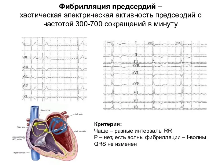 Фибрилляция предсердий – хаотическая электрическая активность предсердий с частотой 300-700 сокращений в