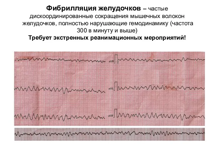 Фибрилляция желудочков – частые дискоординированные сокращения мышечных волокон желудочков, полностью нарушающие гемодинамику