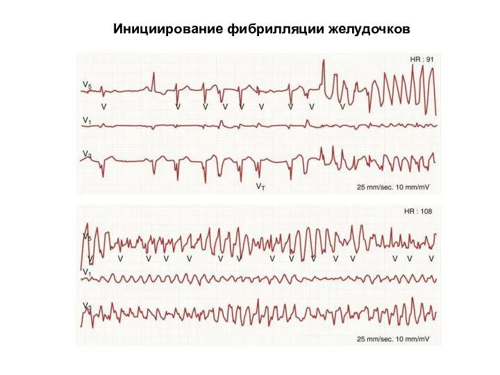 Инициирование фибрилляции желудочков