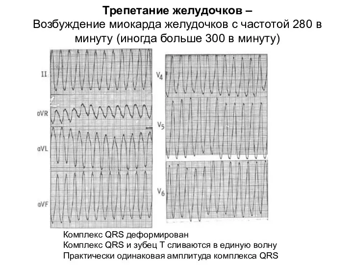 Трепетание желудочков – Возбуждение миокарда желудочков с частотой 280 в минуту (иногда