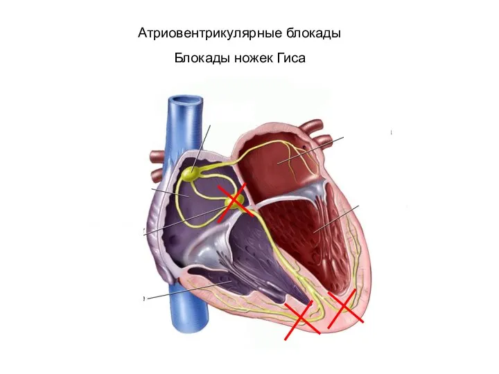 Атриовентрикулярные блокады Блокады ножек Гиса