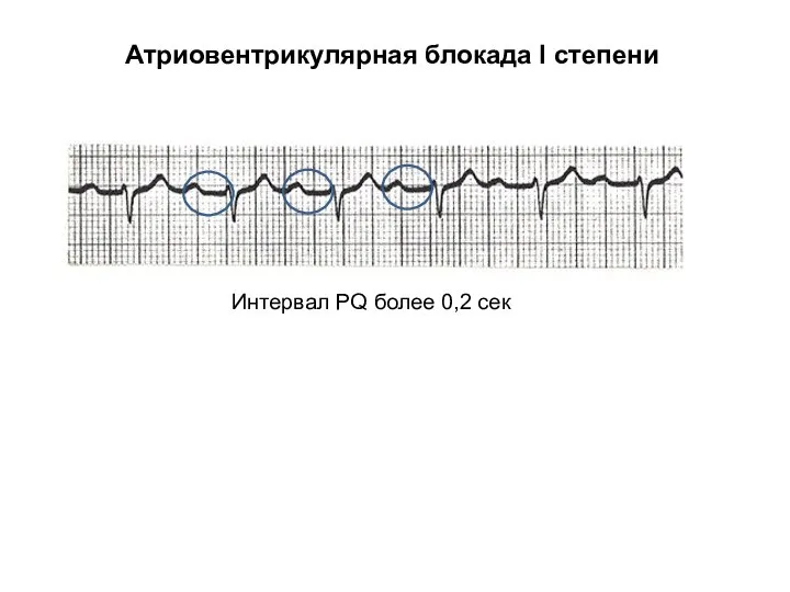 Атриовентрикулярная блокада I степени Интервал PQ более 0,2 сек