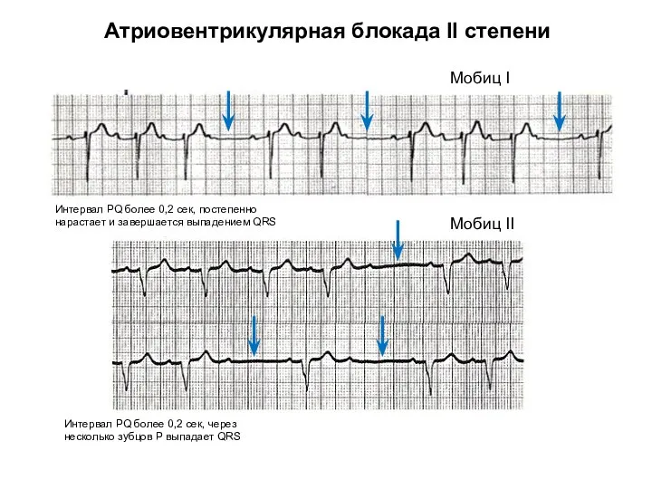 Атриовентрикулярная блокада II степени Мобиц I Мобиц II Интервал PQ более 0,2