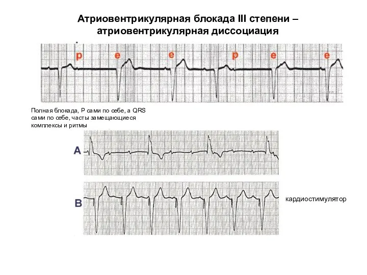 Атриовентрикулярная блокада III степени – атриовентрикулярная диссоциация кардиостимулятор Полная блокада, Р сами